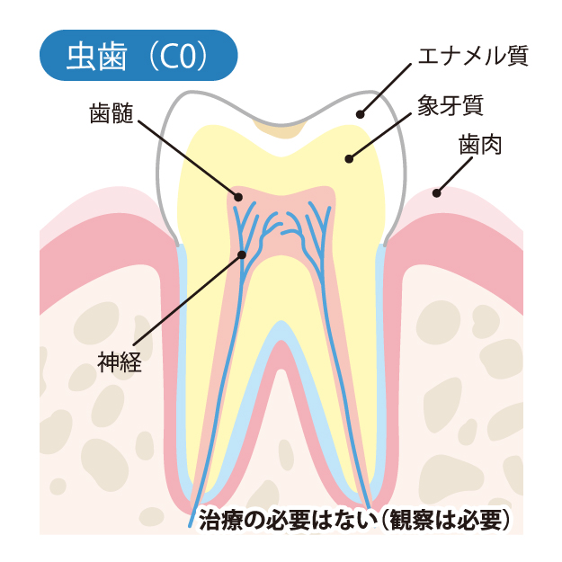 飯田橋の歯医者、飯田橋サンシャイン歯科でむし歯治療